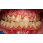 Отзывы о Ультразвуковая зубная щетка