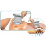 Отзывы о Криолиполиз