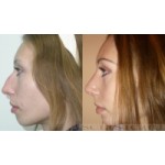 Отзывы о Пластика носа