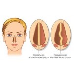 Отзывы о Септопластика