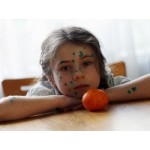 Отзывы о Ветряная оспа (ветрянка)