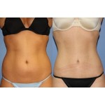 Отзывы о Абдоминопластика