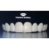 Implant Smiles - съемные виниры